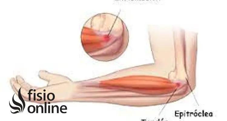 dolor epitroclea motocicleta - Cómo quitar dolor de Epitrocleitis