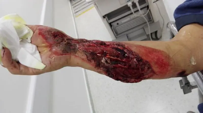 heridas de accidentes de motos - Qué hacer cuando te caes de la moto y te raspas